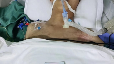 求求大家帮帮我在ICU抢救的弟弟任旭浩